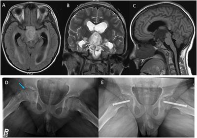 Case report: Slipped capital femoral epiphysis: a rare adverse event associated with FGFR tyrosine kinase inhibitor therapy in a child